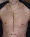 cicatrice cardio