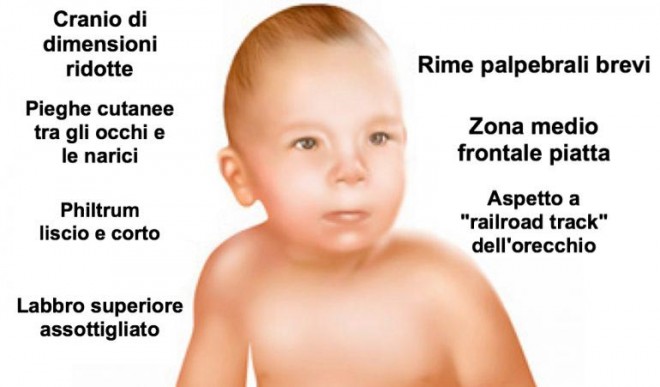 feto alcolica