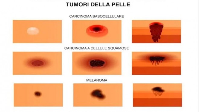 tumori della pelle